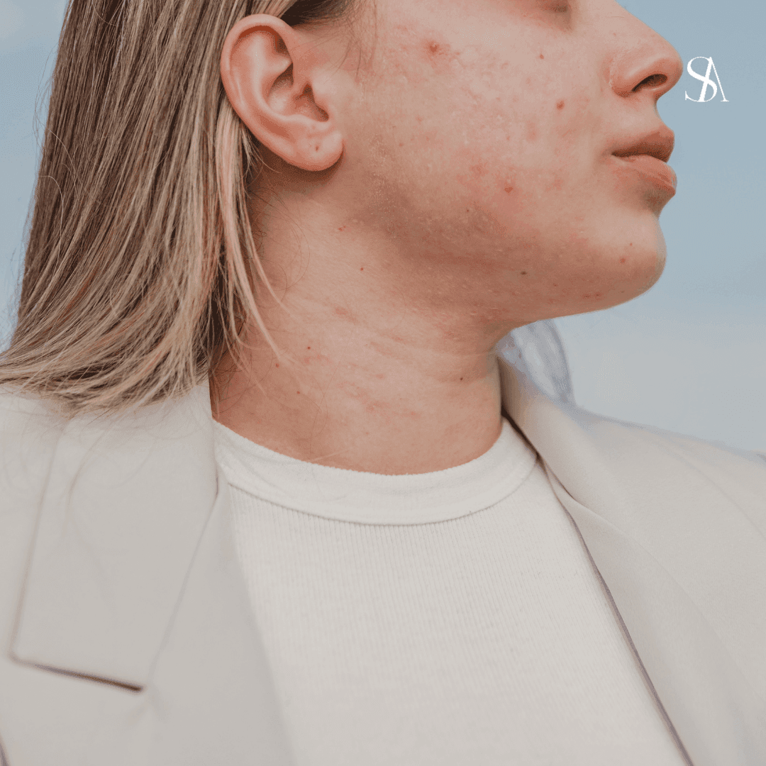 The Acne Vaccine: A New Frontier in Skincare