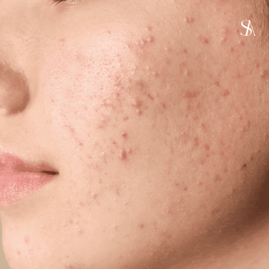 The Link Between Acne and IUDs